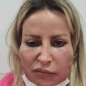 Uzm. Dr. Haydar Ersoy Yanlış Dolgu Sonrası Yüzümde Kalıcı Hasar ve Maddi Kayıp Yaşadım