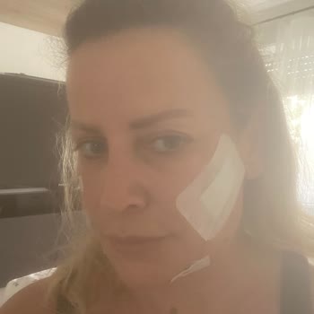 Uzm. Dr. Haydar Ersoy Yanlış Dolgu Sonrası Yüzümde Kalıcı Hasar ve Maddi Kayıp Yaşadım