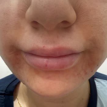 Cilt Bakımı Sonrası Yüzümde Oluşan Yanık Nedeniyle Mağduriyet Ve Tazminat Talebi