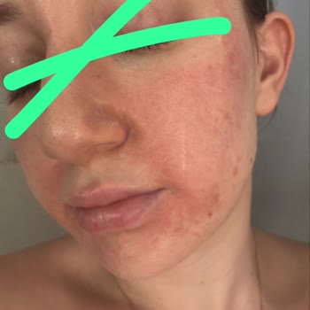 Cilt Bakımı Sonrası Yüzümde Oluşan Yanık Nedeniyle Mağduriyet Ve Tazminat Talebi