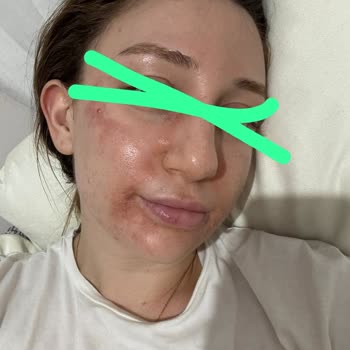 Cilt Bakımı Sonrası Yüzümde Oluşan Yanık Nedeniyle Mağduriyet Ve Tazminat Talebi