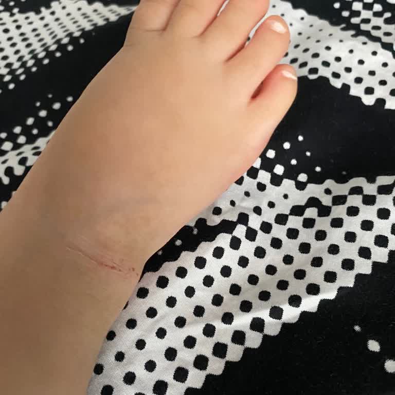 Bir Saat Giyilen Ayakkabı Kızımın Ayağını Tahriş Etti Mağaza İlgisiz Kaldı