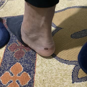 Kısa Sürede Yara Ve Kanama Yapan Ayakkabı İçin İade Talebim Reddedildi