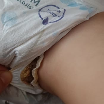 Molfix 5 Numara Bebek Bezi Sızdırıyor Ve Oğlumun Konforunu Olumsuz Etkiliyor