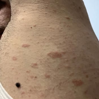 Tüy Dökücü Krem Sonrası Yaşadığım Ciddi Alerjik Reaksiyon Ve Mağduriyet