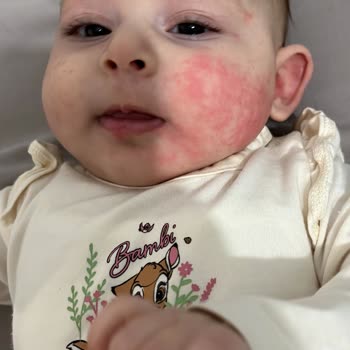 Bioderma Atoderm Intensive Baume Bebeğimde Cilt Reaksiyonu Oluşturdu