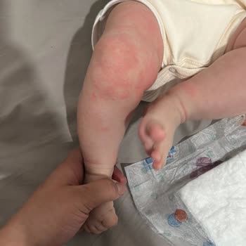 Bioderma Atoderm Intensive Baume Bebeğimde Cilt Reaksiyonu Oluşturdu