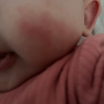 Bioderma Atoderm Intensive Baume Bebeğimde Cilt Reaksiyonu Oluşturdu