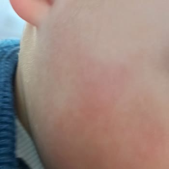 Bebek Losyonunda Koku Ve Cilt Reaksiyonu, Eczaneden Çözüm Alamama Hayal Kırıklığı