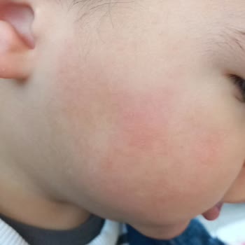 Bebek Losyonunda Koku Ve Cilt Reaksiyonu, Eczaneden Çözüm Alamama Hayal Kırıklığı