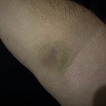 Kadıköy Medicana Acil Servisinde Dikkatsiz Uygulamalar, Yetersiz Bilgilendirme Ve Haksız Ücretlendirme Sonucu Mağduriyet