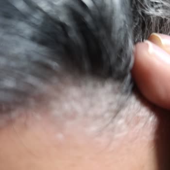 Bioxin Collagen Şampuan Saç Derimde Ciddi Sorunlara Yol Açtı