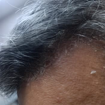 Bioxin Collagen Şampuan Saç Derimde Ciddi Sorunlara Yol Açtı