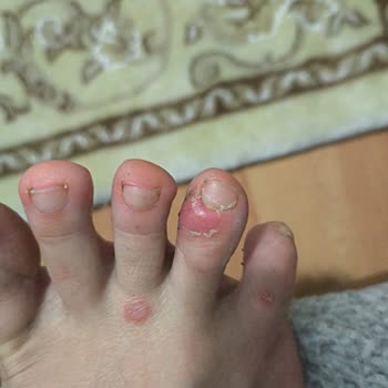 Tedi Mağazasından Alınan Ayak Maskesi Sağlık Sorunlarına Yol Açtı