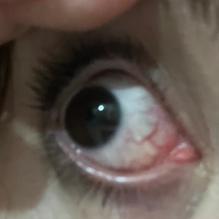 Siveno Yüz Temizleme Köpüğü Gözde Şiddetli Yanma Ve Sağlık Riski