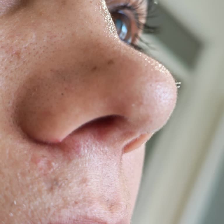 Doç. Dr. Süay Özmen Burun Estetiği Sonrası Belirgin Şekil Bozukluğu Ve Simetri Kaybı Yaşadım