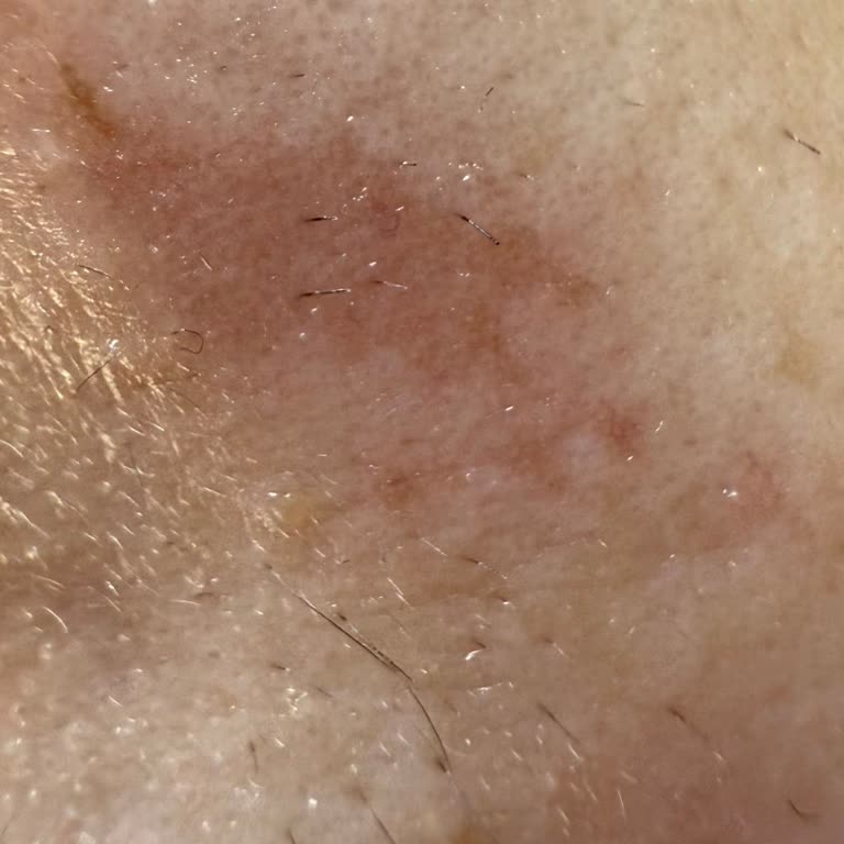 Hassas Ciltler İçin Üretilen Ağda Bandı Cildimi Tahriş Etti!