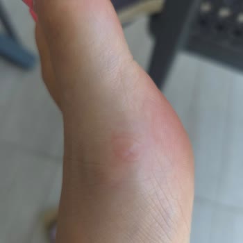 Sandalias UGG me lastimaron el pie, solicito cambio o reembolso