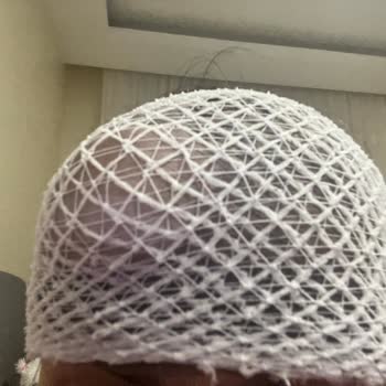 One Hair Clinic Kayıt Dışı Eksozom Uygulaması Sonrası Sağlık Sorunları Ve Belgesiz İşlem Mağduriyeti