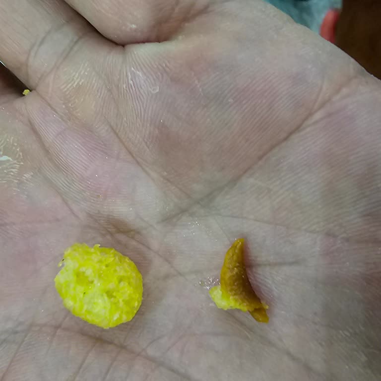 Satın Aldığım Üründen Çıkan Yabancı Cisim Sağlığımı Tehdit Ediyor!