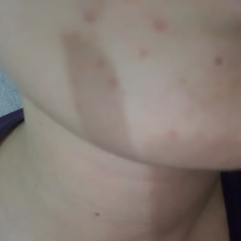 Neutrogena Sivilce Serumu Cildimde Daha Fazla Sivilceye Yol Açtı