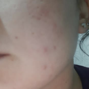 Neutrogena Sivilce Serumu Cildimde Daha Fazla Sivilceye Yol Açtı