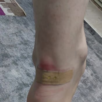 Yeni Alınan Ayakkabı Ayağımı Yaraladı, Yetersiz İnceleme Mağduriyetimi Artırdı