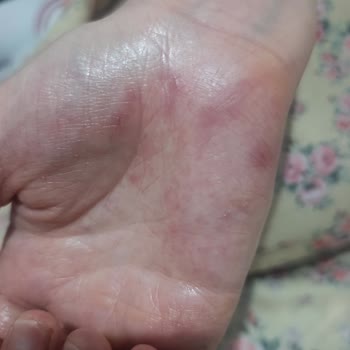 Bulaşık Deterjanı Ellerde Ciddi Sağlık Sorunlarına Yol Açtı