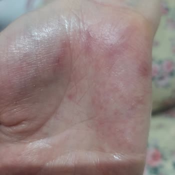 Bulaşık Deterjanı Ellerde Ciddi Sağlık Sorunlarına Yol Açtı