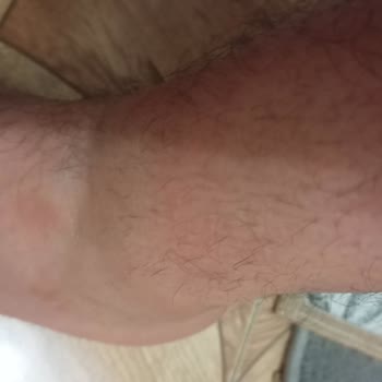 Duru Duş Jeli Cildimde Alerji Ve Kaşıntıya Sebep Oldu