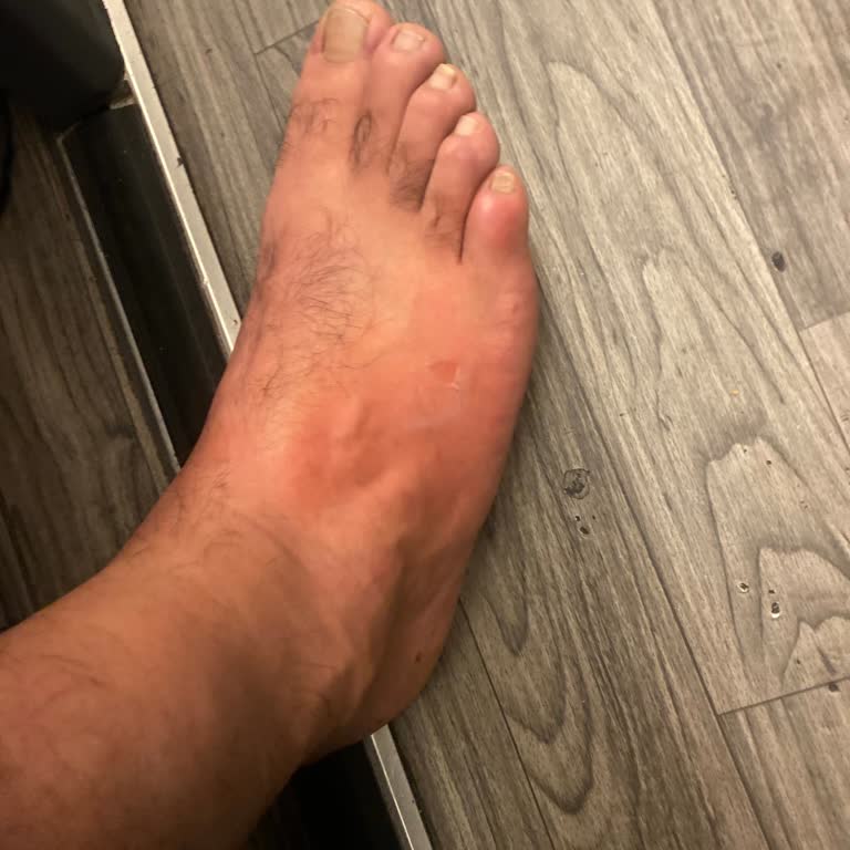 Otobüste Düşme Sonrası Yanık Ve Görevlilerin İlgisizliği Nedeniyle Mağduriyet Yaşadım