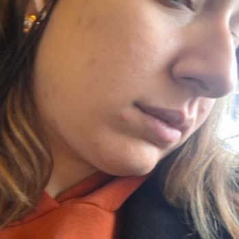 Maruderm Cica Krem Cildimde Sivilceye Yol Açtı, İade Talep Ediyorum