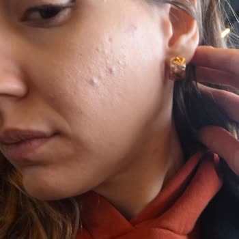 Maruderm Cica Krem Cildimde Sivilceye Yol Açtı, İade Talep Ediyorum