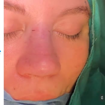 Burun Estetiği Sonrası Hayal Kırıklığı Ve Revizyon Sorunu