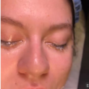 Burun Estetiği Sonrası Hayal Kırıklığı Ve Revizyon Sorunu