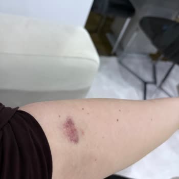 Kolan Hastanesi'nde Kan Alma Sırasında Yaşadığım Ağrılı Ve İlgisiz Yaklaşım Güvenimi Sarsıldı