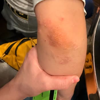 OMO Express Fresh Sıvı Deterjan Nedeniyle Tip 1 Diyabet Hastası Oğlumda Şiddetli Alerjik Reaksiyon Ve Mağduriyet