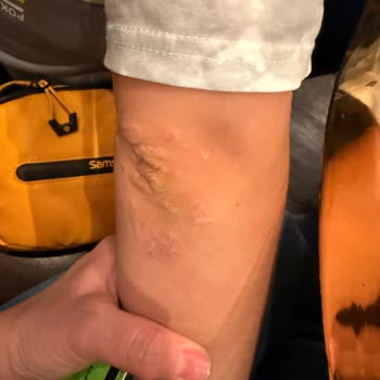 OMO Express Fresh Sıvı Deterjan Nedeniyle Tip 1 Diyabet Hastası Oğlumda Şiddetli Alerjik Reaksiyon Ve Mağduriyet