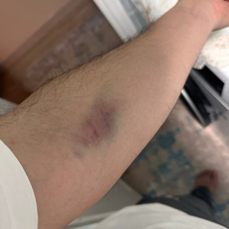 Kan Alımı Sonrası Şişlik Ve Morarma: Daha Fazla Özen Bekliyorum