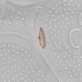 Pınar Sosiste Kemik Parçası Çıktı