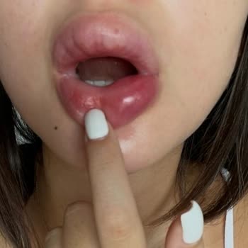 Dudak Dolgusu Sonrası Yaşadığım Sağlık Sorunları Ve Mağduriyet