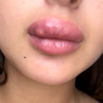 Dudak Dolgusu Sonrası Yaşadığım Sağlık Sorunları Ve Mağduriyet