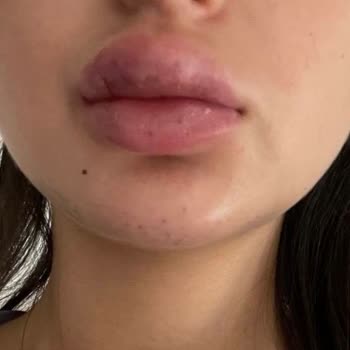 Dudak Dolgusu Sonrası Yaşadığım Sağlık Sorunları Ve Mağduriyet