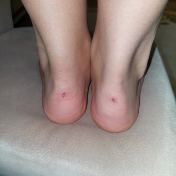 Lumberjack Ayakkabıda Topukta Sert Cisim Nedeniyle Sağlık Sorunu Ve Mağduriyet