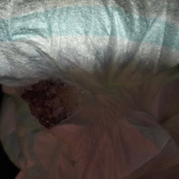 Molfix Bebek Bezinde Küf Ve İletişimsizlik Nedeniyle Yaşadığımız Sağlık Riski