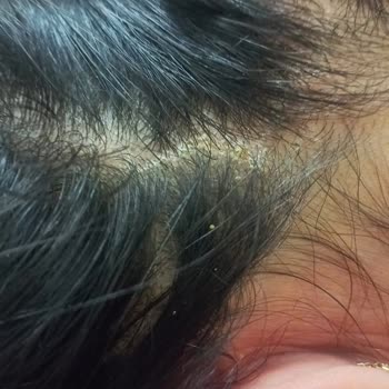 Sapanca Grand Wooden Havuzdaki Kimyasal Dengesizlik Nedeniyle Sağlık Sorunu Ve Ücret İade Talebi!