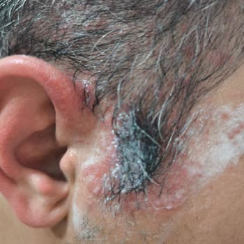 Sea Color Man Black Shampoo Kullandıktan Sonra Ciddi Alerjik Reaksiyon Ve Sağlık Sorunları Yaşadım