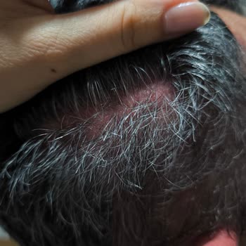 Sea Color Man Black Shampoo Kullandıktan Sonra Ciddi Alerjik Reaksiyon Ve Sağlık Sorunları Yaşadım