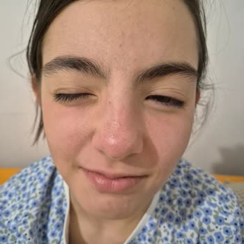 Yves Rocher Alerjik Cilt Uyarıma Rağmen Önerilen Ürün Kızımda Ciddi Reaksiyona Yol Açtı