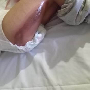 Çocuğumun Ameliyat Sonrası Batikon Yanığına Maruz Kalması Ve Hastane İhmalinden Kaynaklanan Mağduriyet